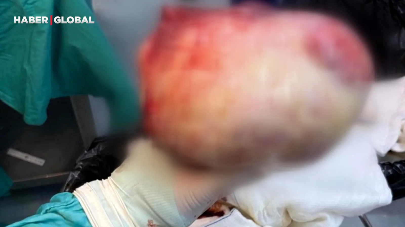 60 Yaşındaki Kadının Karnındaki Şok Edici Kitle