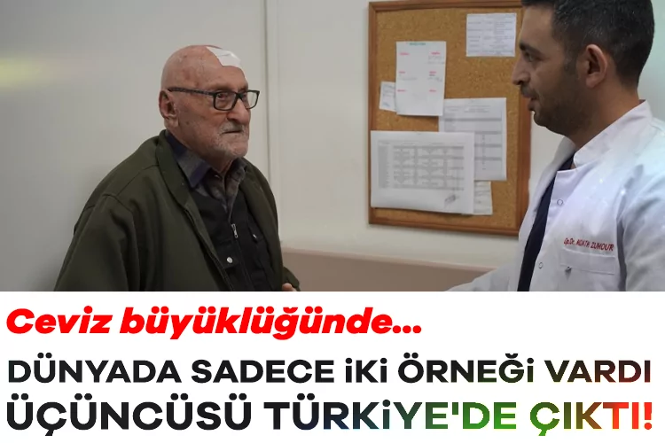 Dünyada Üçüncü Vaka: Ceviz Büyüklüğünde Tümör!