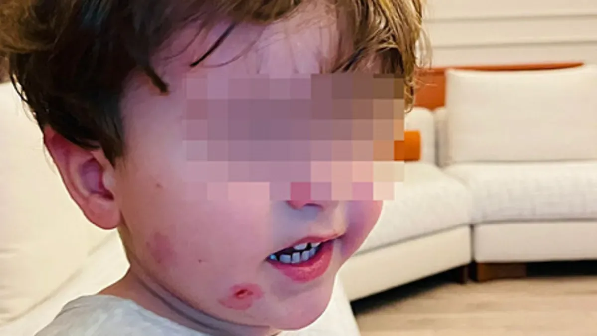 Kreşte Şok: Çocuk Darp Edildi, Soruşturma Başladı!