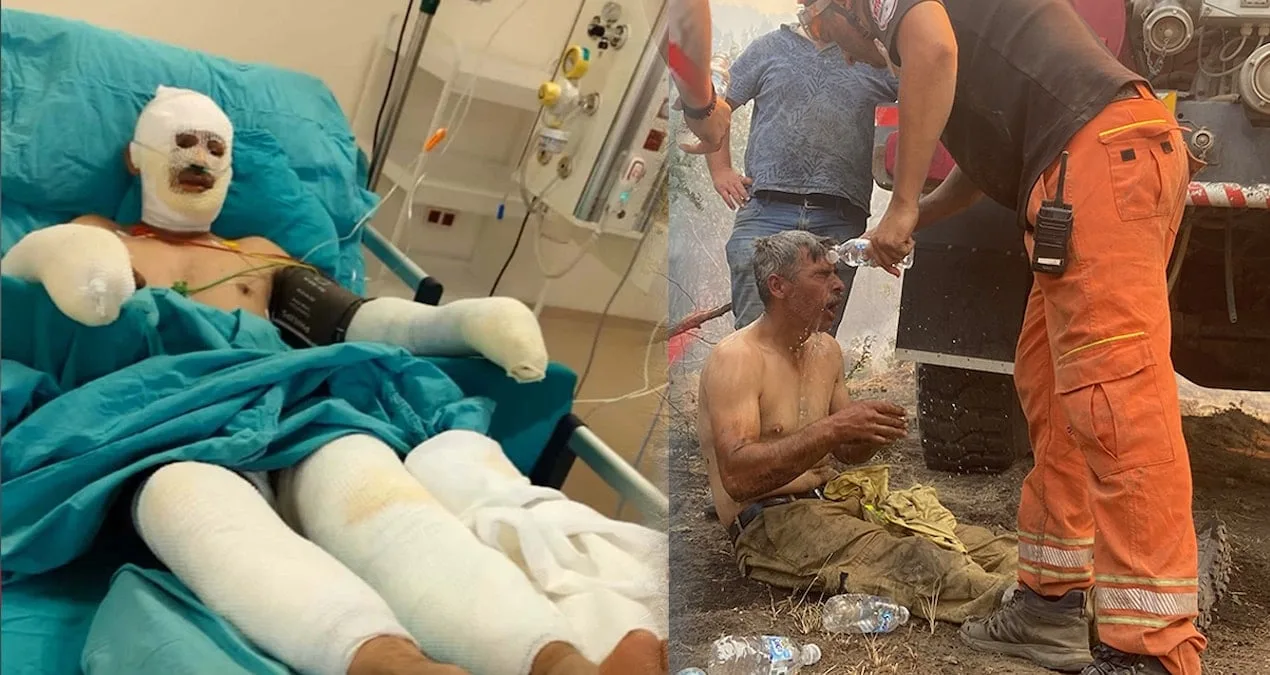Yangında Yaralanan Orman İşçisinin Tedavisi Devam Ediyor